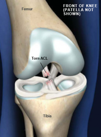 What you dont see - mental struggles of tearing the ACL